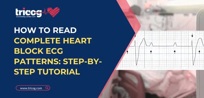 How to Read Complete Heart Block ECG Patterns: Step-by-Step Tutorial